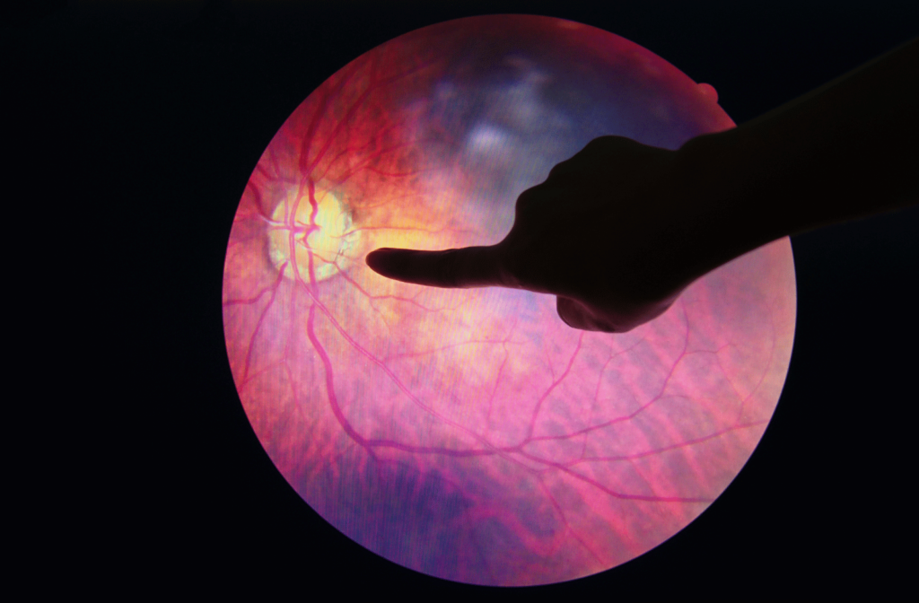An eye doctor pointing at an abnormality in the eye, most likely diabetic retinopathy
