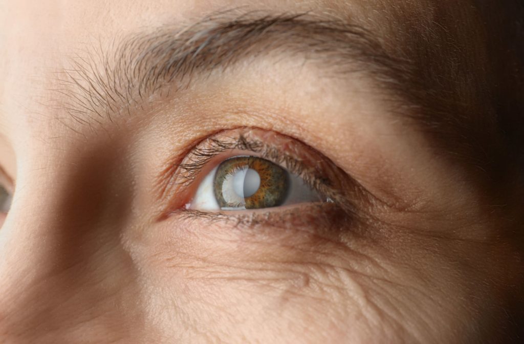 A close up view of a woman's eye with a cataract present