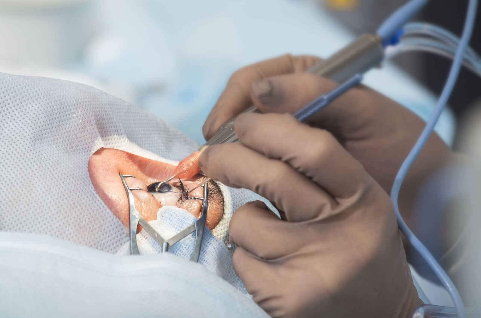 A closeup of a patient undergoing cataract surgery.