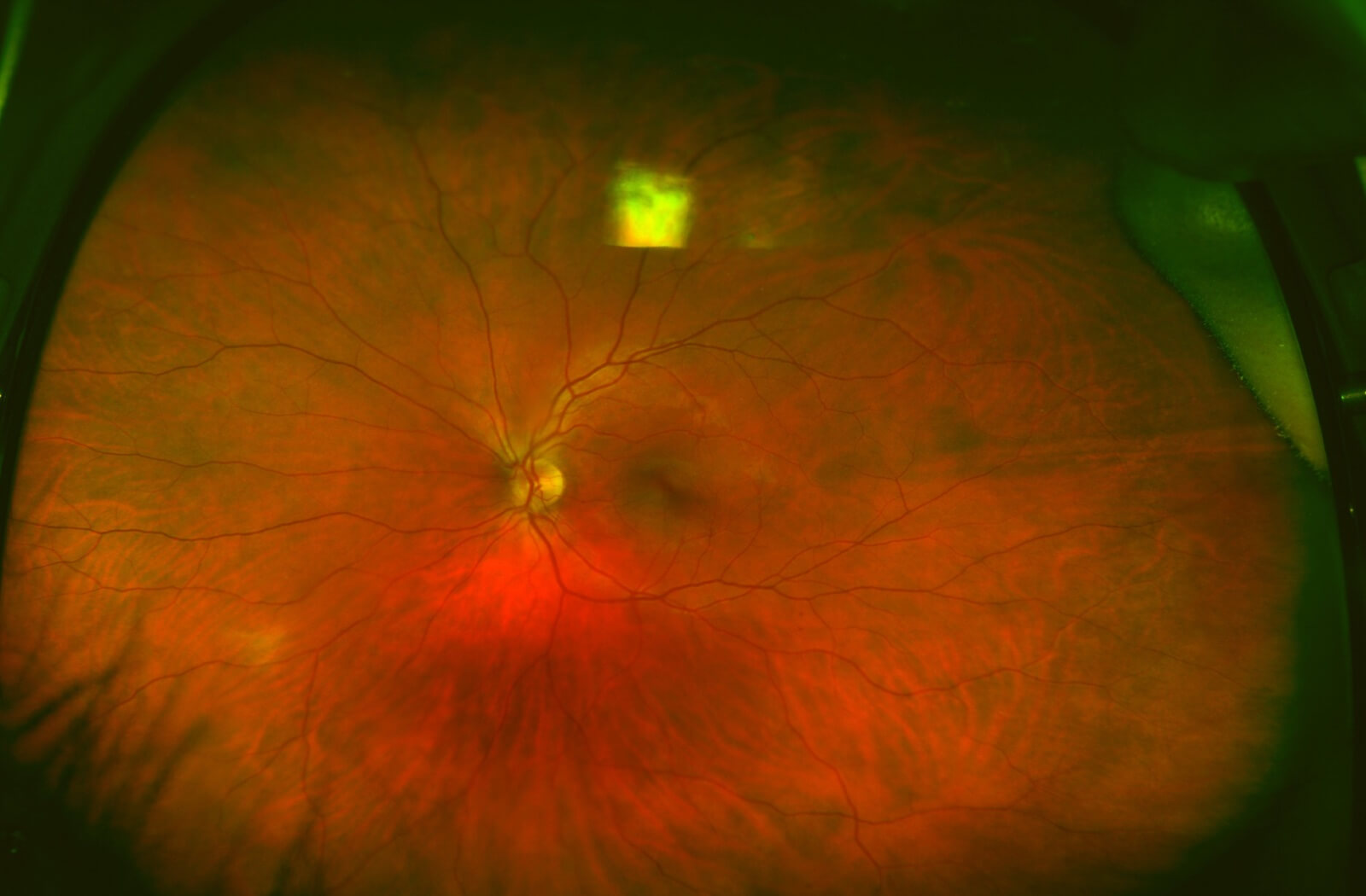 Widefield retinal image showing the optic nerve and detailed structures of the retina in red, orange, and green tones.