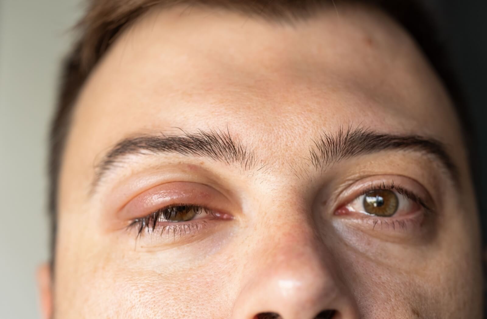 Close-up of a person with a swollen, red upper eyelid on one eye, showing irritation and puffiness.