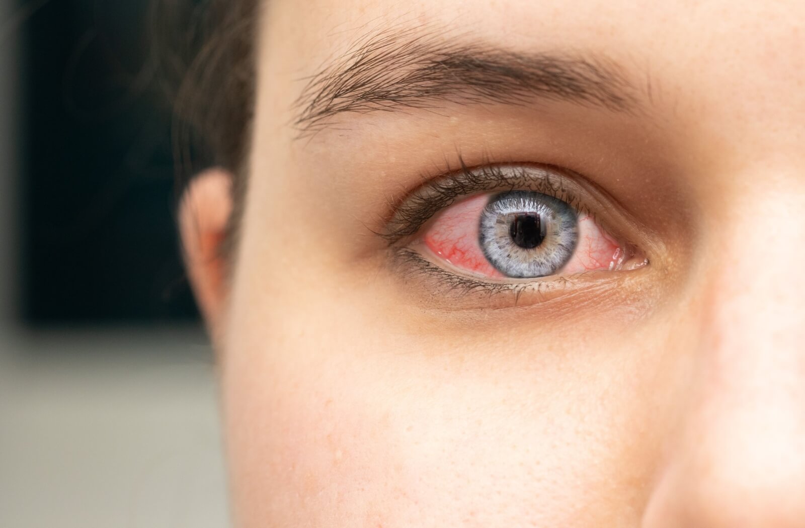 A close-up of an individual’s eye with significant redness and irritation in the sclera.